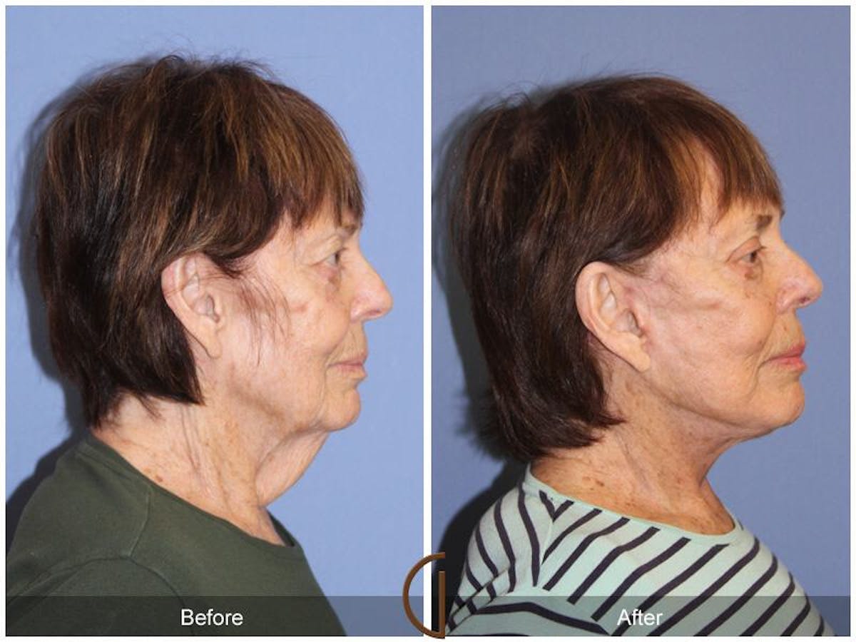 Facelift 70s Before & After Gallery - Patient 113980 - Image 3
