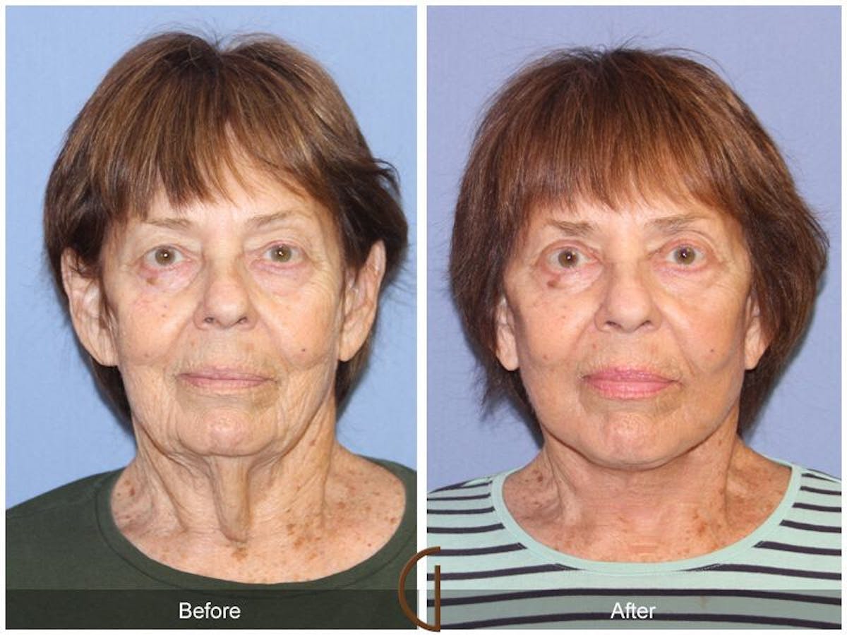 Facelift 70s Before & After Gallery - Patient 113980 - Image 2
