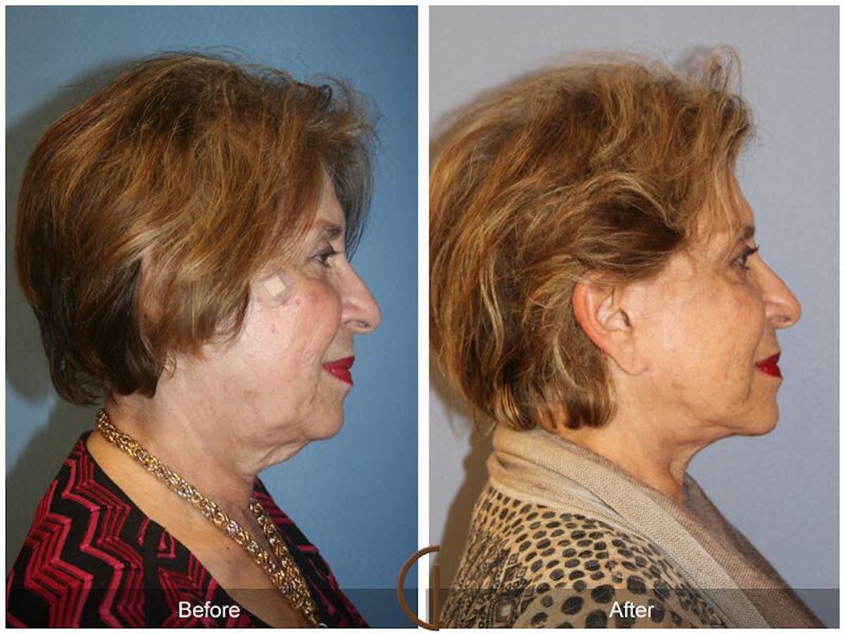 Facelift 70s Before & After Gallery - Patient 377655 - Image 3