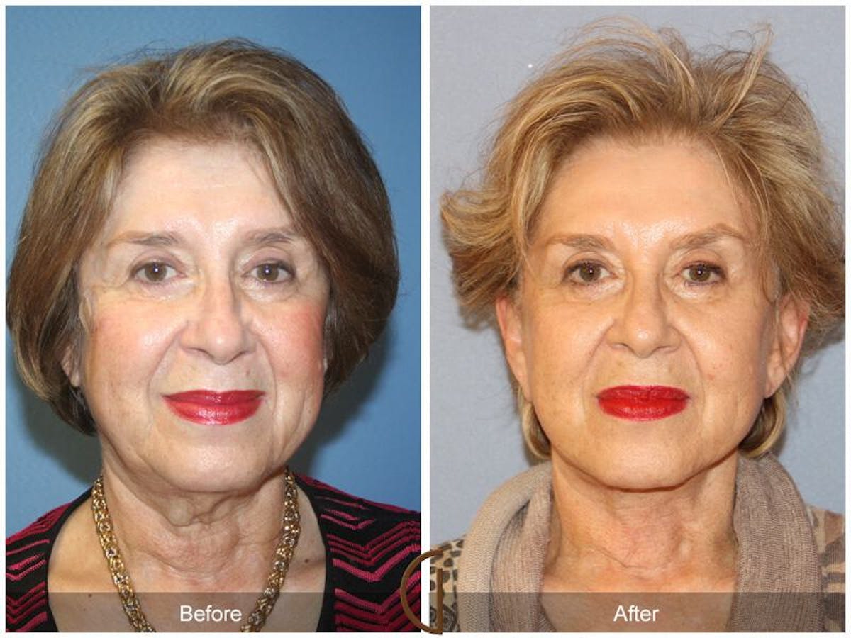 Facelift 70s Before & After Gallery - Patient 377655 - Image 2