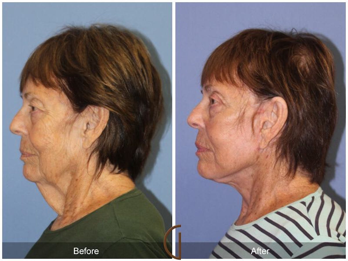 Facelift 70s Before & After Gallery - Patient 113980 - Image 1