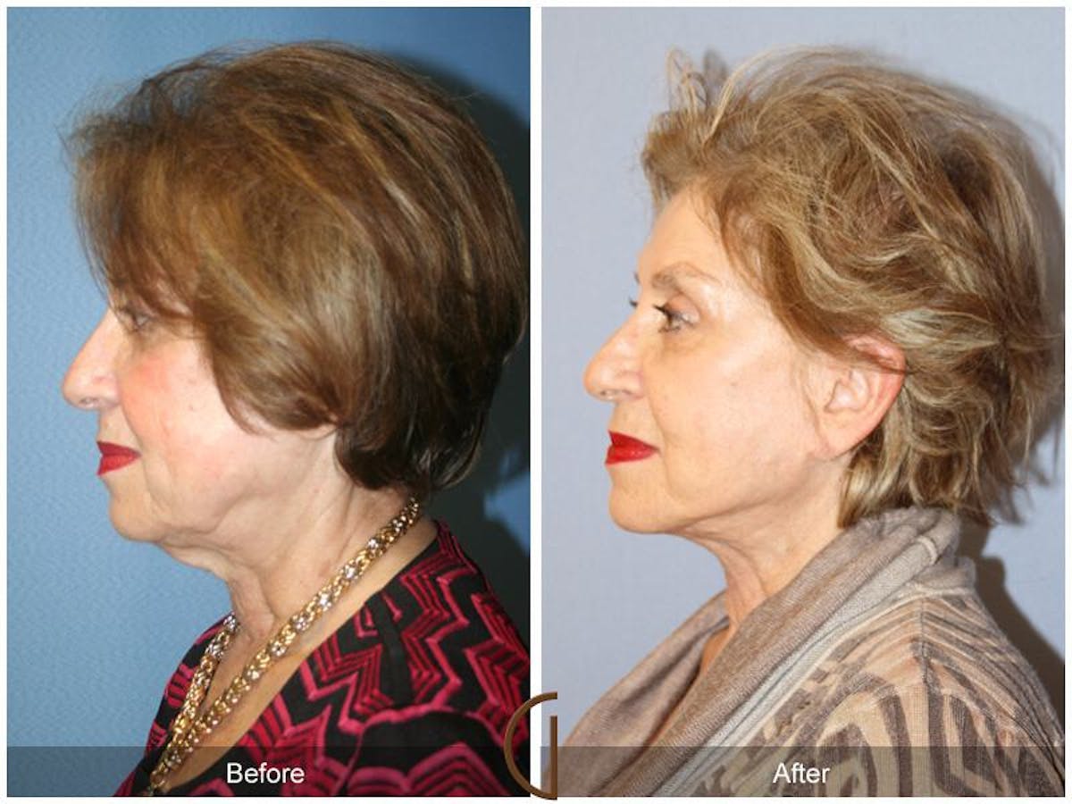 Facelift 70s Before & After Gallery - Patient 377655 - Image 1