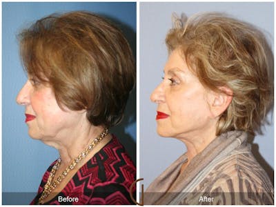 Facelift 70s Before & After Gallery - Patient 377655 - Image 1