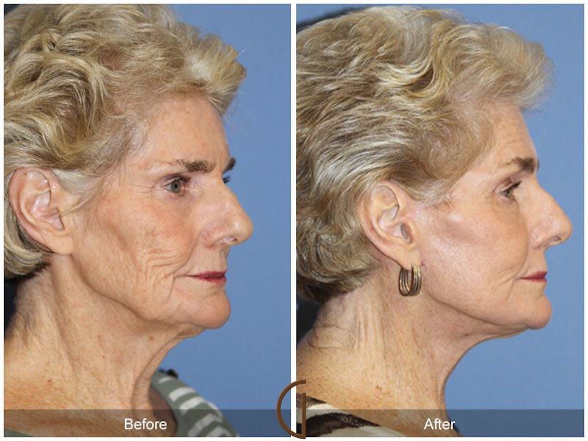 Facelift 70s Before & After Gallery - Patient 121631 - Image 3