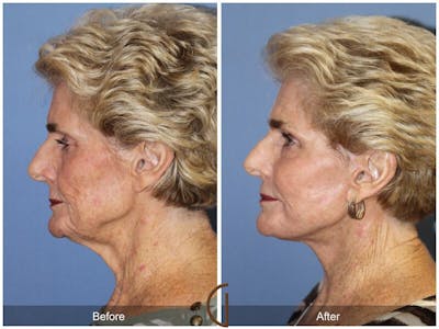 Facelift 70s Before & After Gallery - Patient 121631 - Image 1