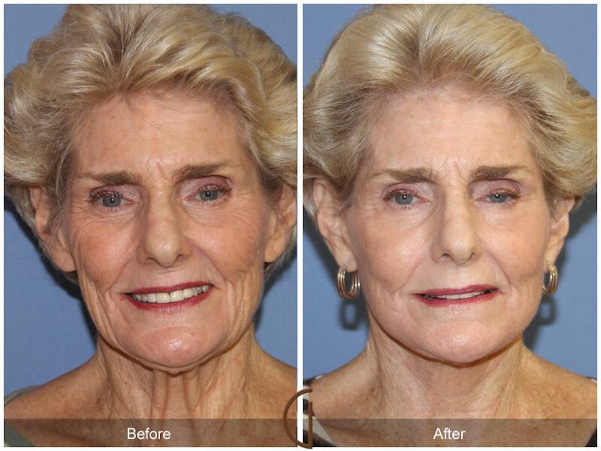 Facelift 70s Before & After Gallery - Patient 121631 - Image 2