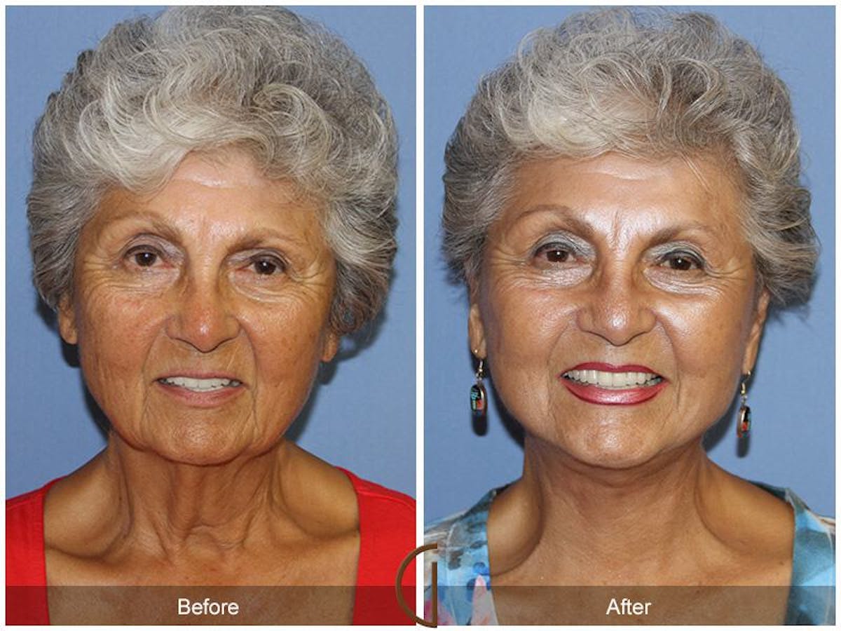 Facelift 70s Before & After Gallery - Patient 285778 - Image 2