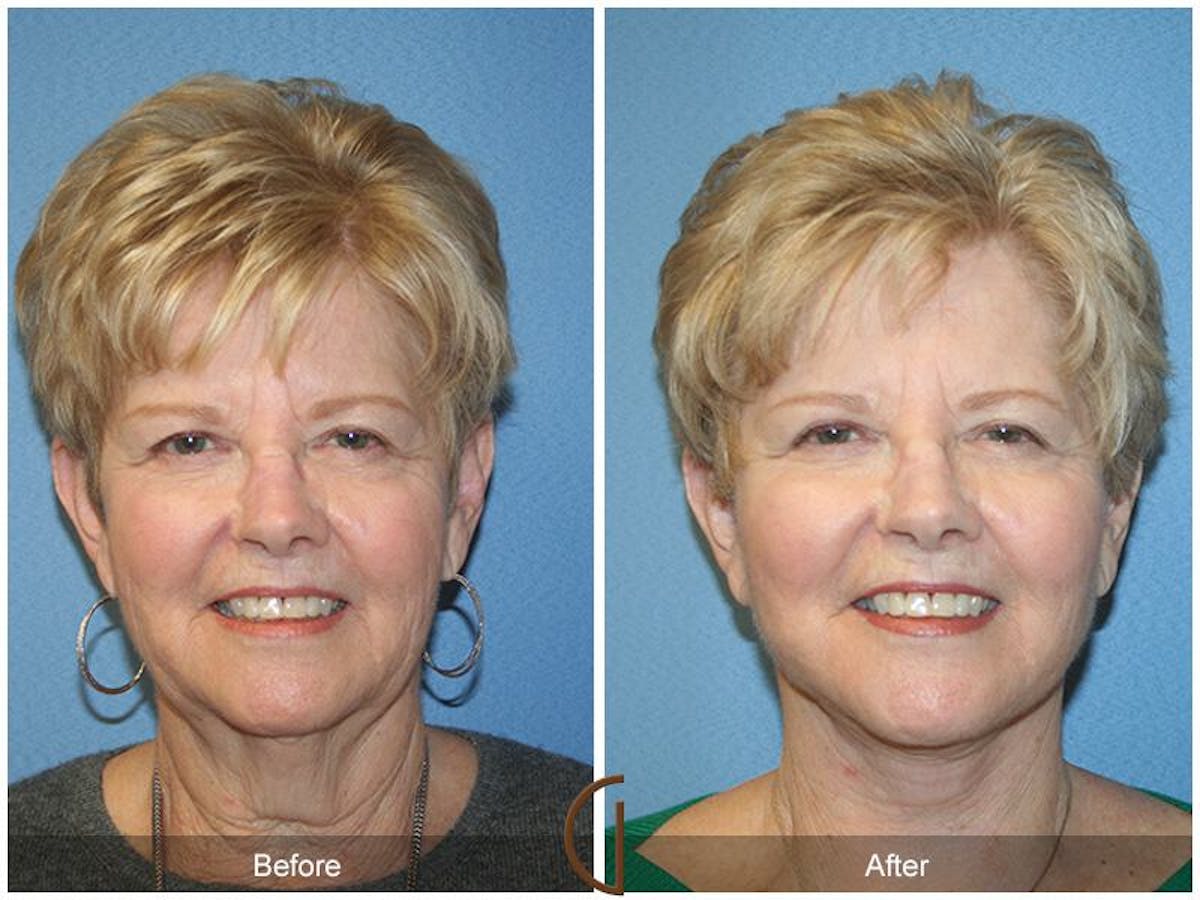 Facelift 70s Before & After Gallery - Patient 190036 - Image 2