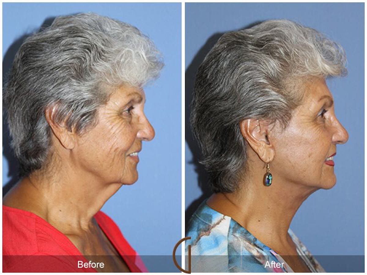Facelift 70s Before & After Gallery - Patient 285778 - Image 3