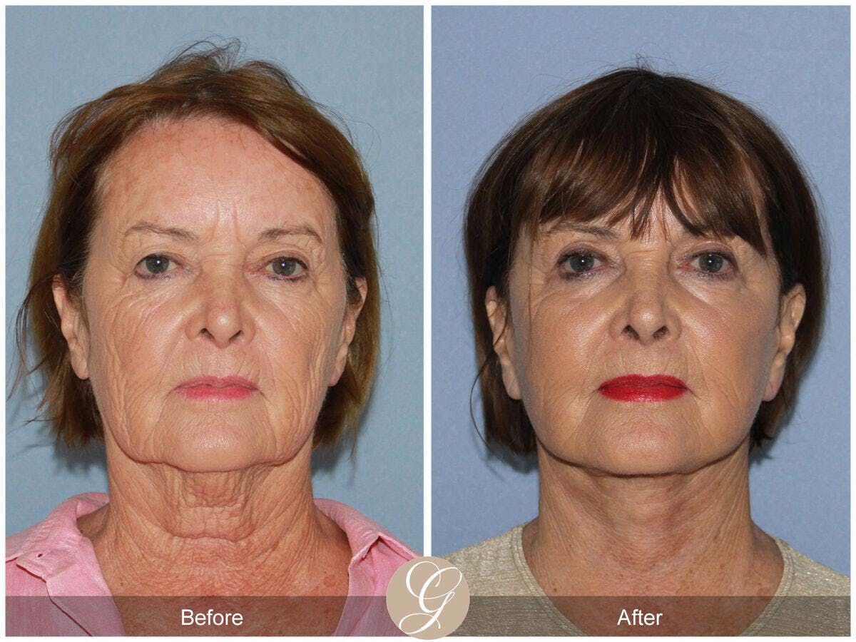 Facelift 70s Before & After Gallery - Patient 118860 - Image 2