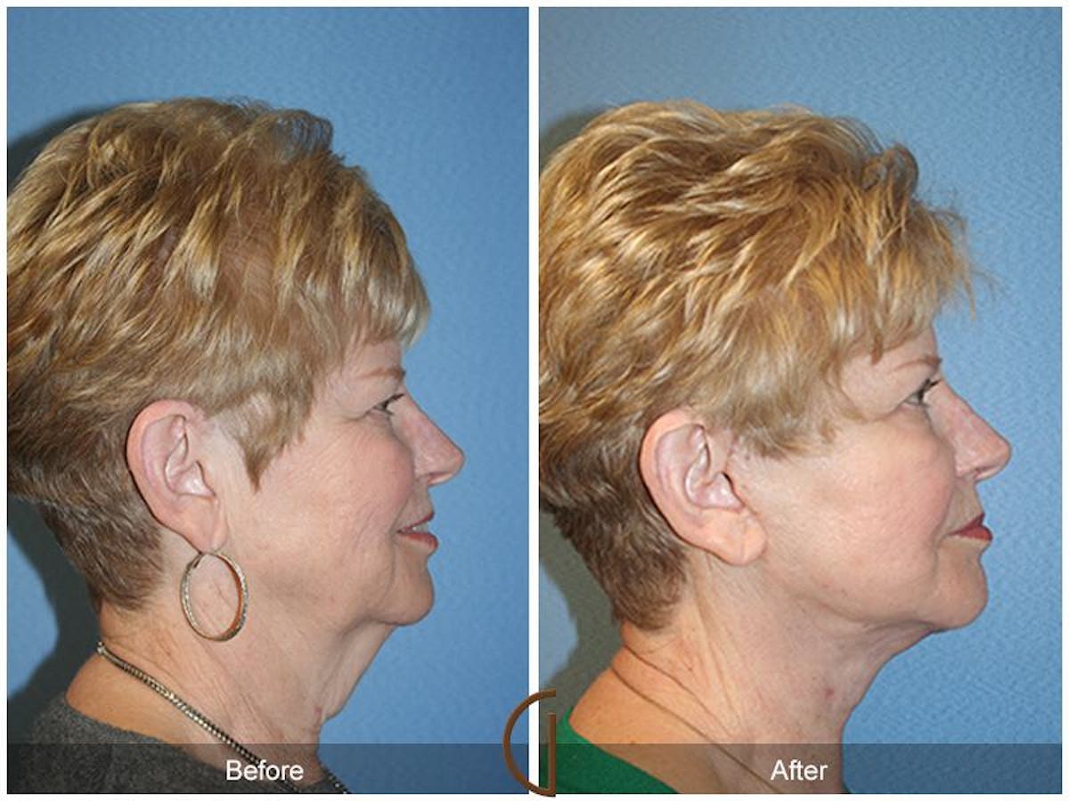 Facelift 70s Before & After Gallery - Patient 190036 - Image 3