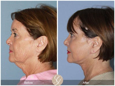 Facelift 70s Before & After Gallery - Patient 118860 - Image 1