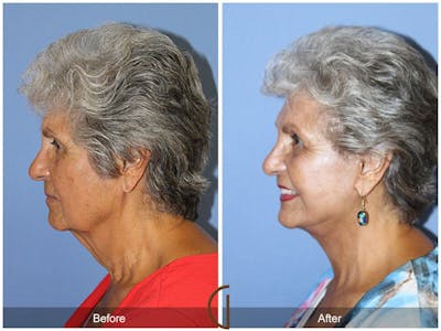 Facelift 70s Before & After Gallery - Patient 285778 - Image 1