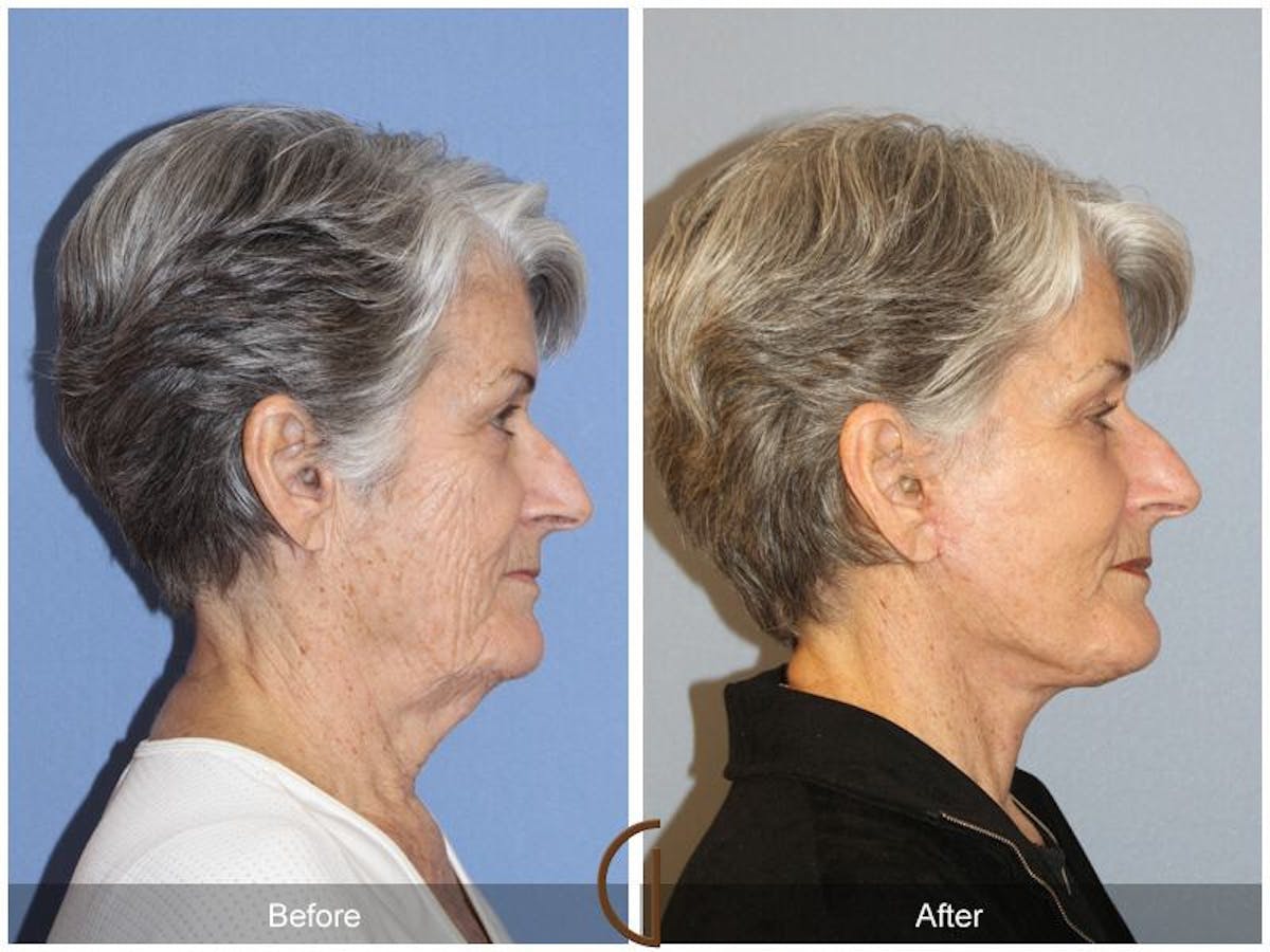 Facelift 70s Before & After Gallery - Patient 181977 - Image 3