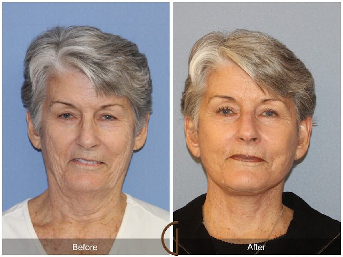 Facelift 70s Before & After Gallery - Patient 181977 - Image 2