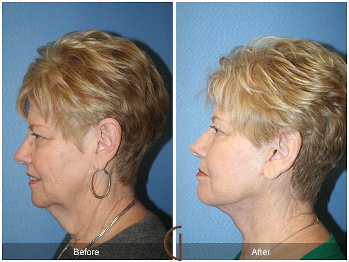 Facelift 70s Before & After Gallery - Patient 190036 - Image 1