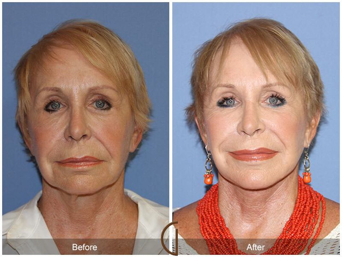 Facelift 70s Before & After Gallery - Patient 911006 - Image 2