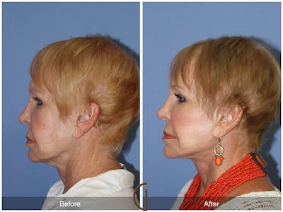 Facelift 70s Before & After Gallery - Patient 911006 - Image 1
