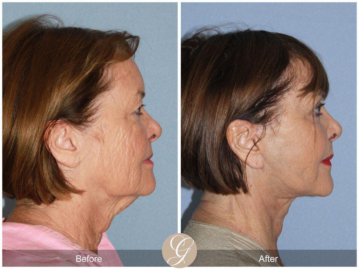 Facelift 70s Before & After Gallery - Patient 118860 - Image 3