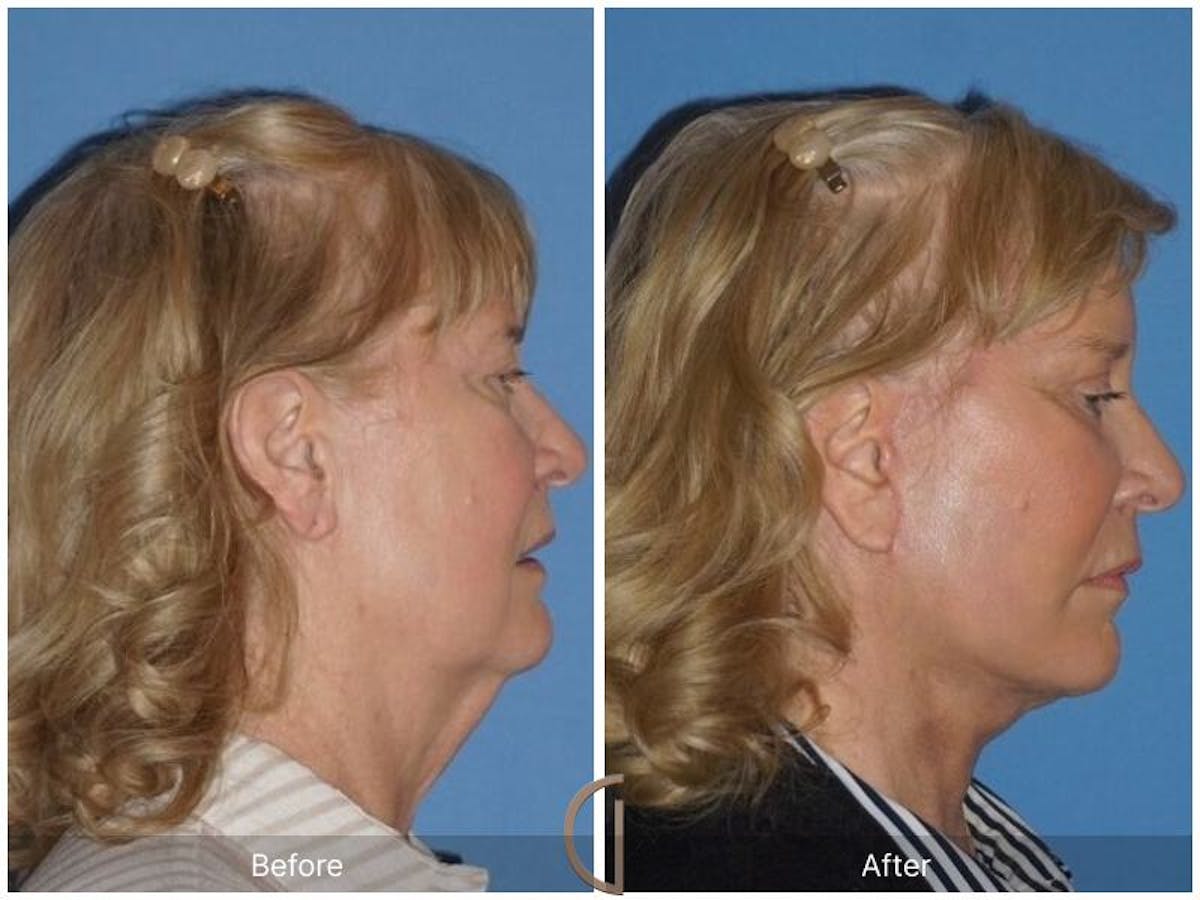 Facelift 60s Before & After Gallery - Patient 483821 - Image 3