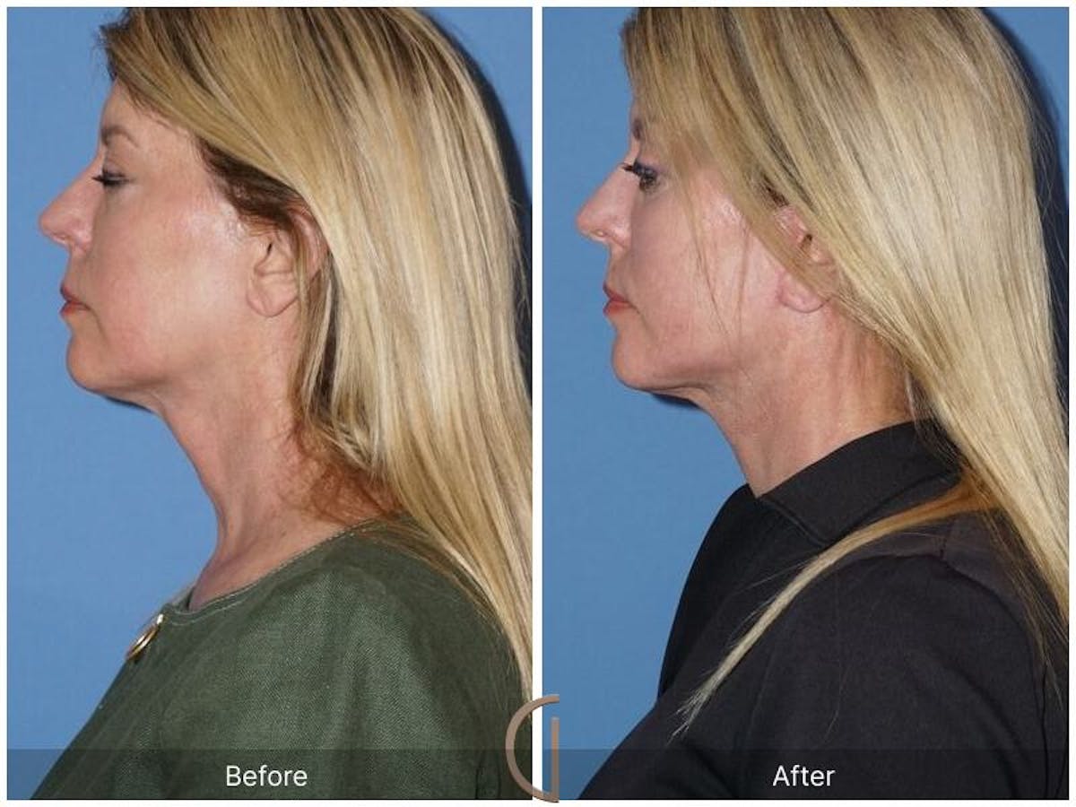 Facelift 60s Before & After Gallery - Patient 215569 - Image 1