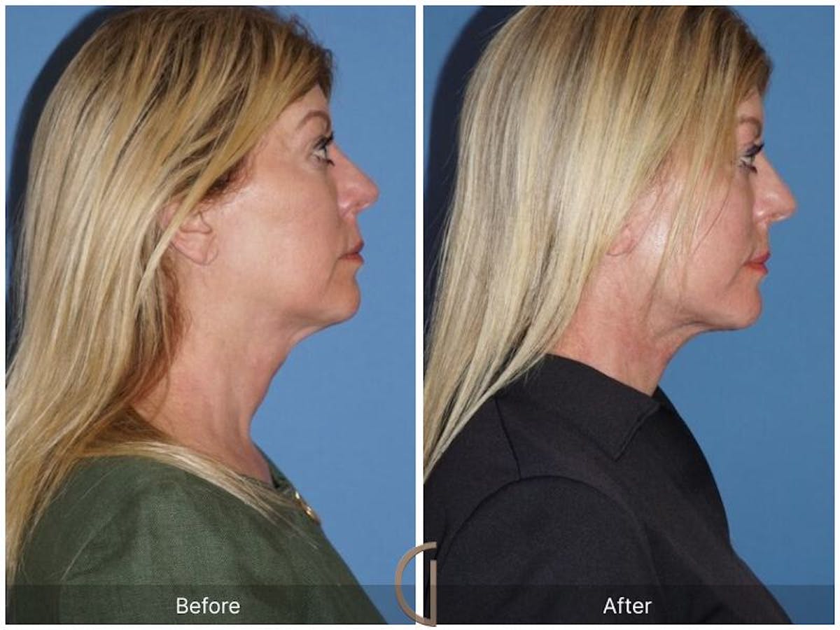 Facelift 60s Before & After Gallery - Patient 215569 - Image 3