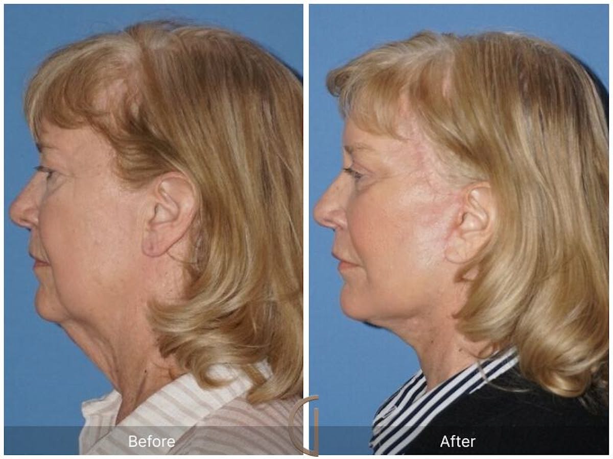 Facelift 60s Before & After Gallery - Patient 483821 - Image 1
