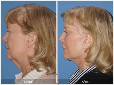 Facelift 60s Before & After Gallery - Patient 483821 - Image 1