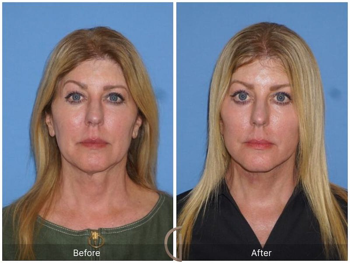Facelift 60s Before & After Gallery - Patient 215569 - Image 2