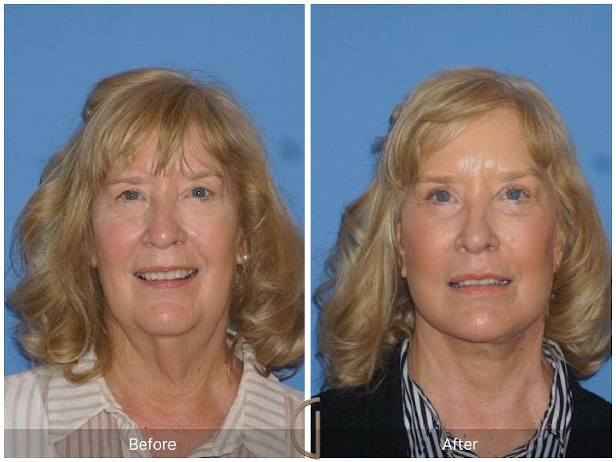 Facelift 60s Before & After Gallery - Patient 483821 - Image 2