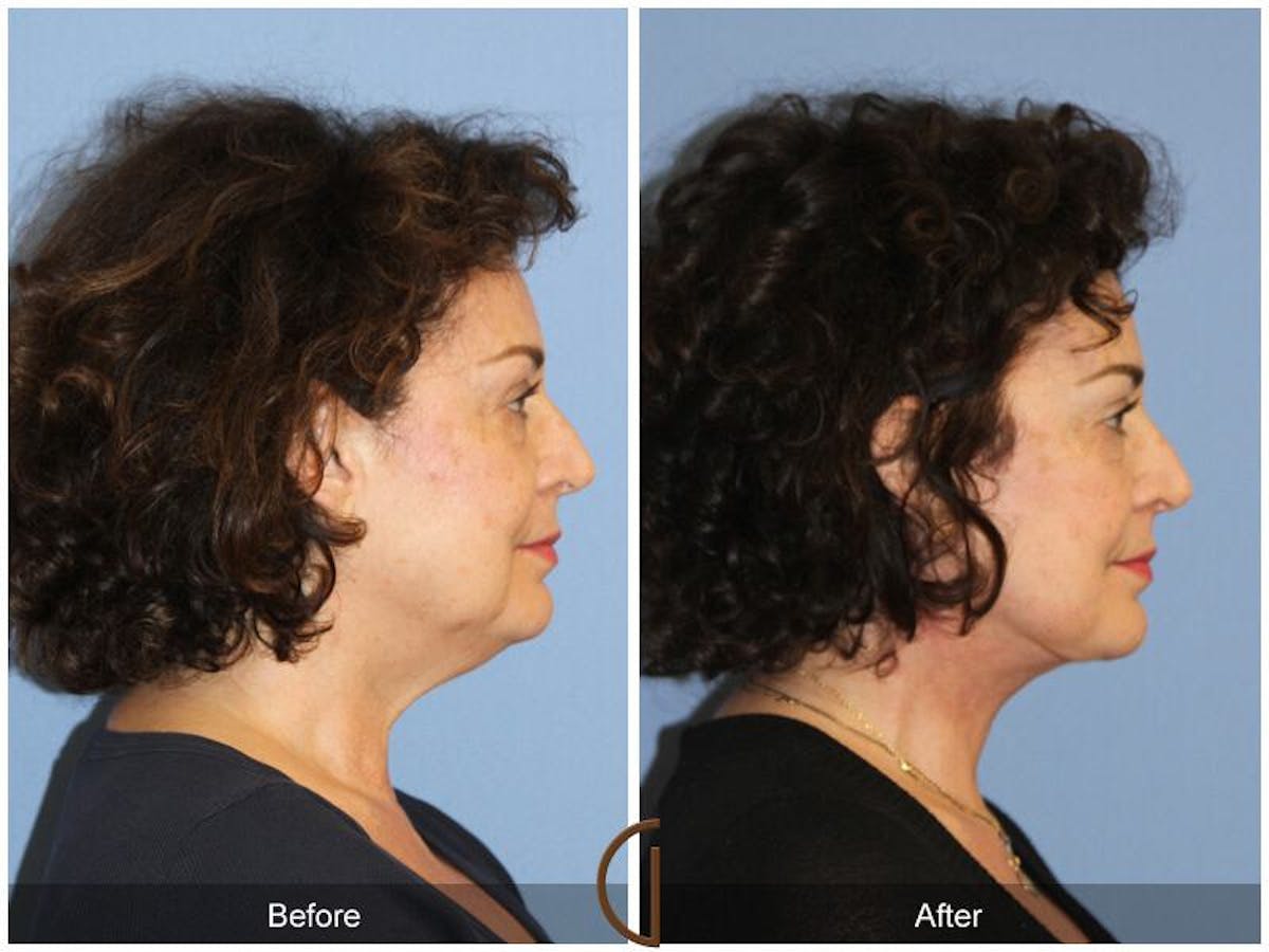 Facelift 60s Before & After Gallery - Patient 409303 - Image 3