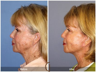 Facelift 60s Before & After Gallery - Patient 138907 - Image 1