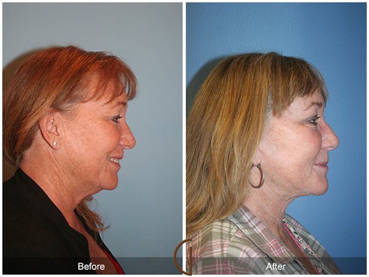 Facelift 60s Before & After Gallery - Patient 745465 - Image 3