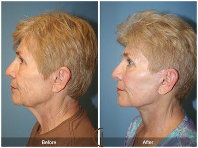 Facelift 60s Before & After Gallery - Patient 296321 - Image 1