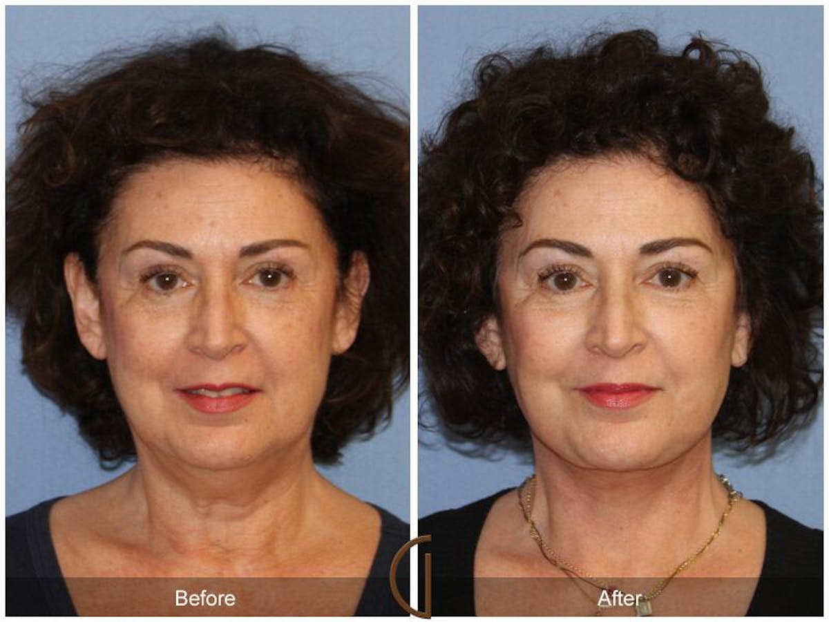 Facelift 50s Before & After Gallery - Patient 714973 - Image 2