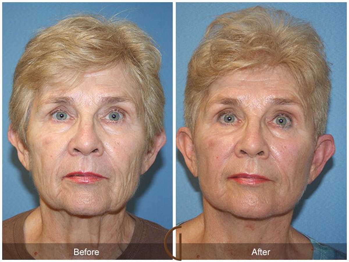 Facelift 60s Before & After Gallery - Patient 296321 - Image 2