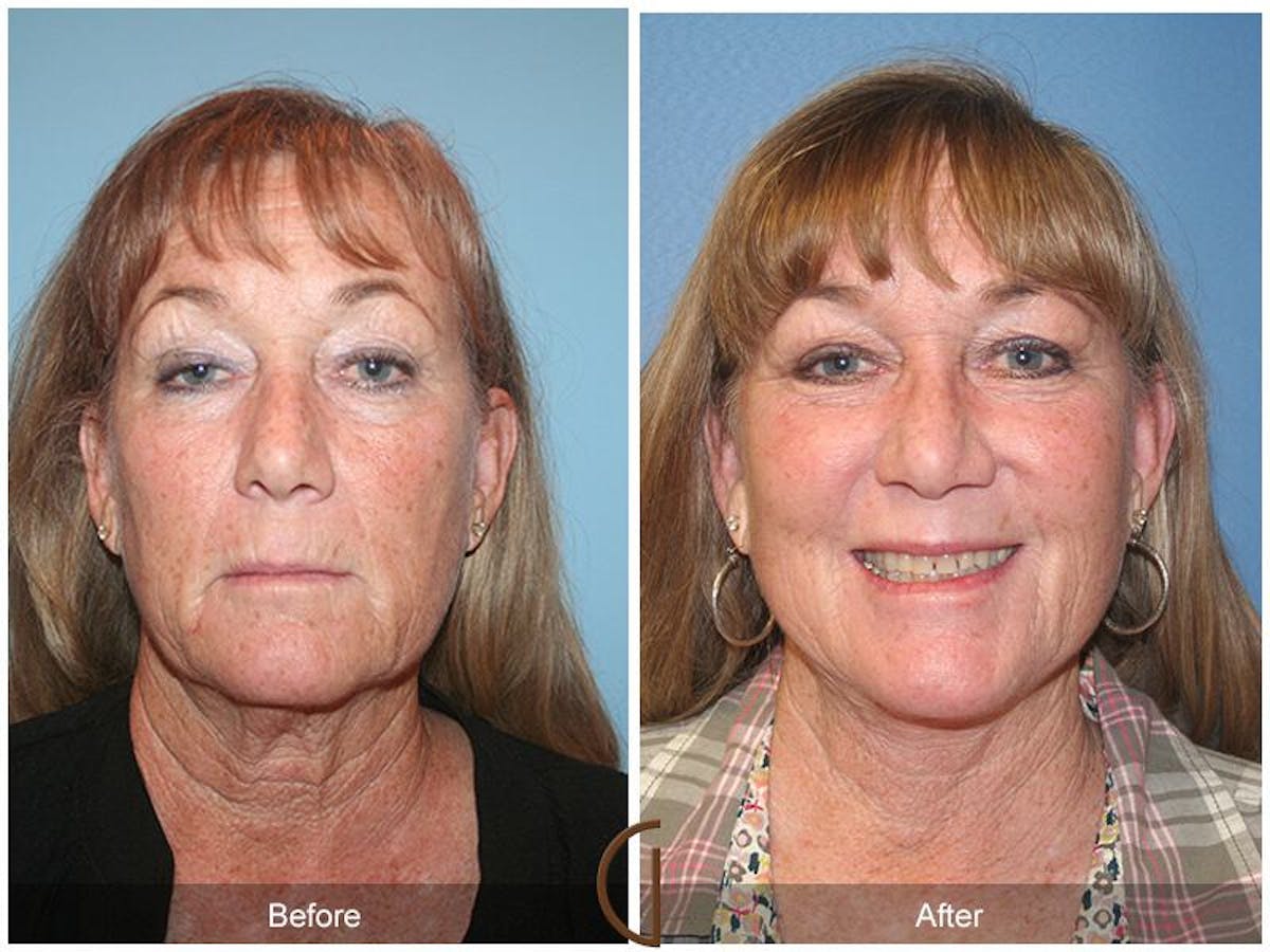 Facelift 60s Before & After Gallery - Patient 745465 - Image 2
