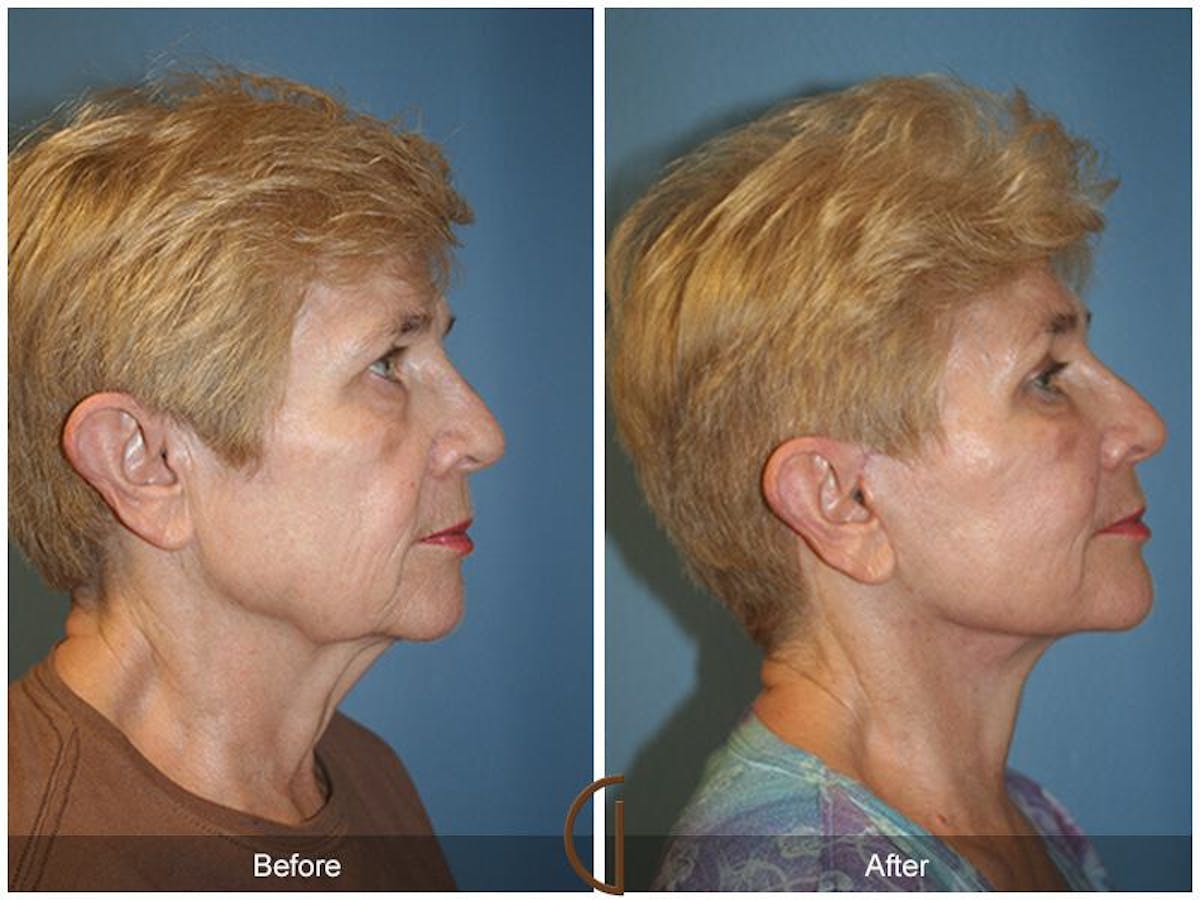 Facelift 60s Before & After Gallery - Patient 296321 - Image 3