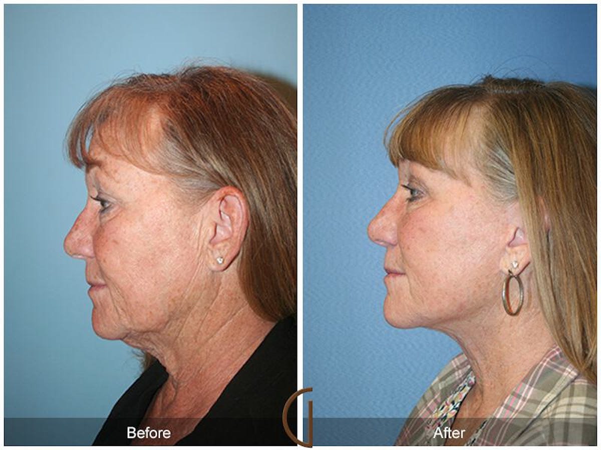Facelift 60s Before & After Gallery - Patient 745465 - Image 1