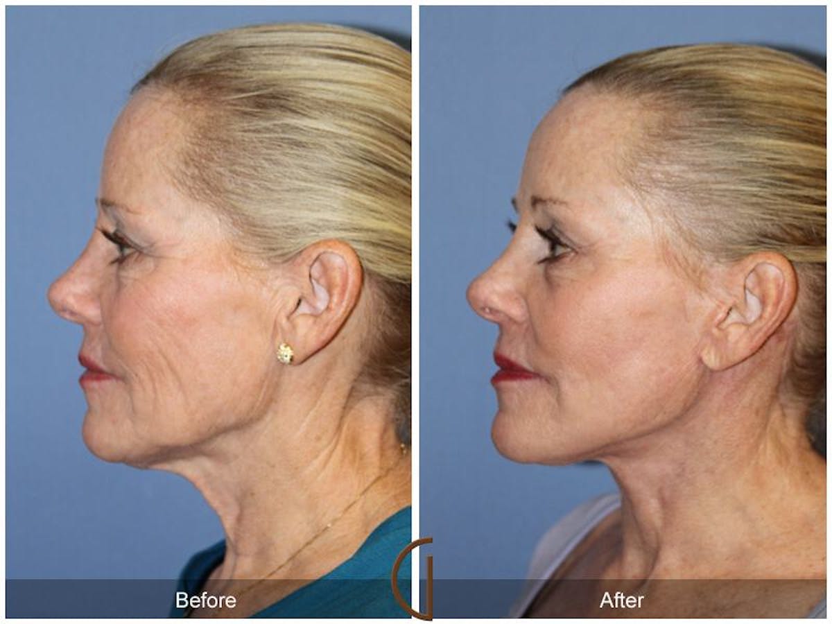 Facelift 60s Before & After Gallery - Patient 321373 - Image 1