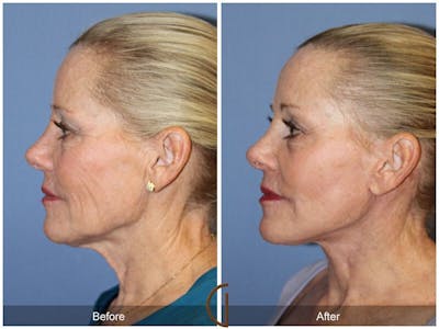 Facelift 60s Before & After Gallery - Patient 321373 - Image 1