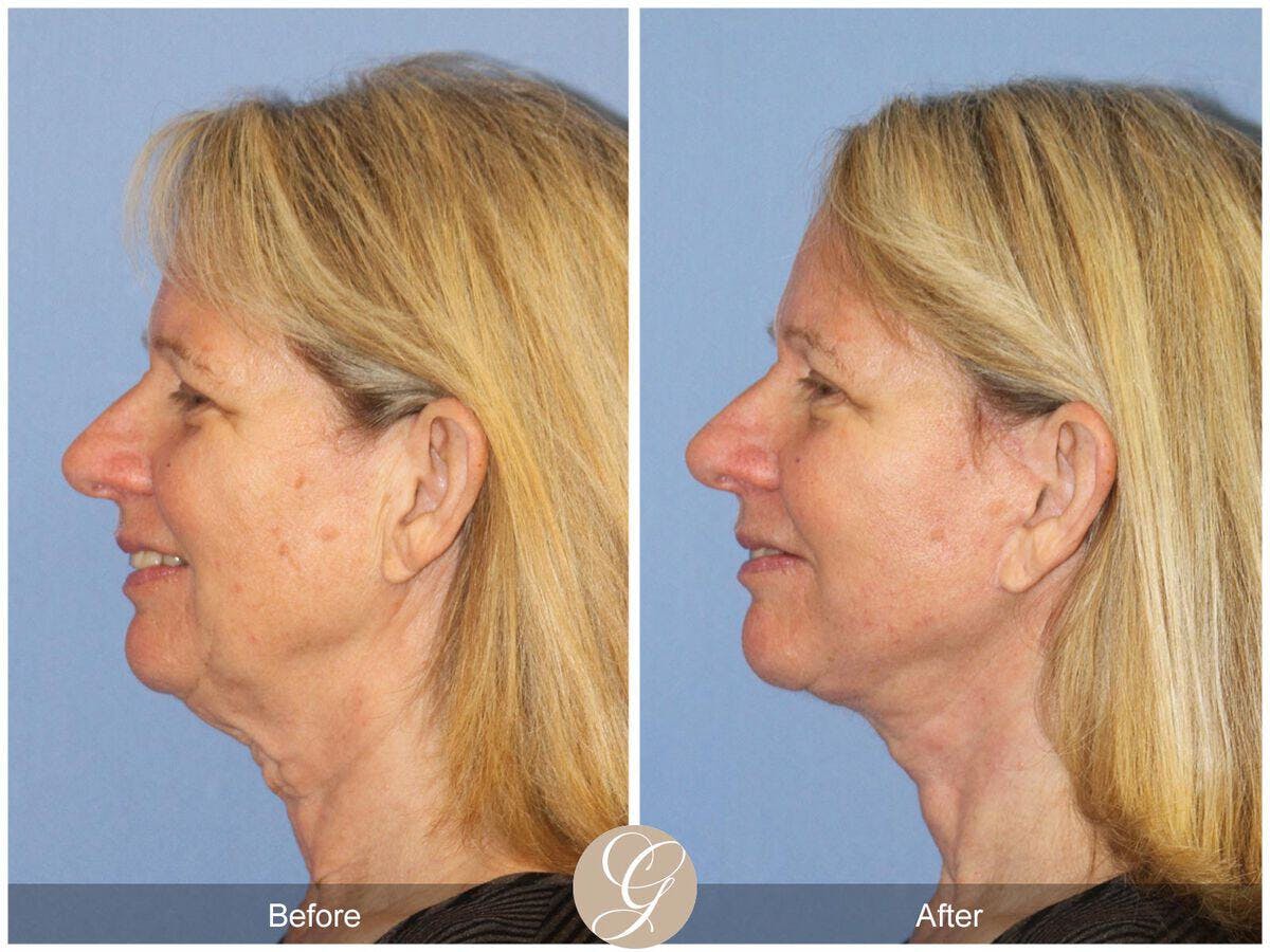 Facelift 60s Before & After Gallery - Patient 210319 - Image 1