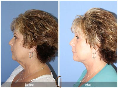 Facelift 60s Before & After Gallery - Patient 428618 - Image 1