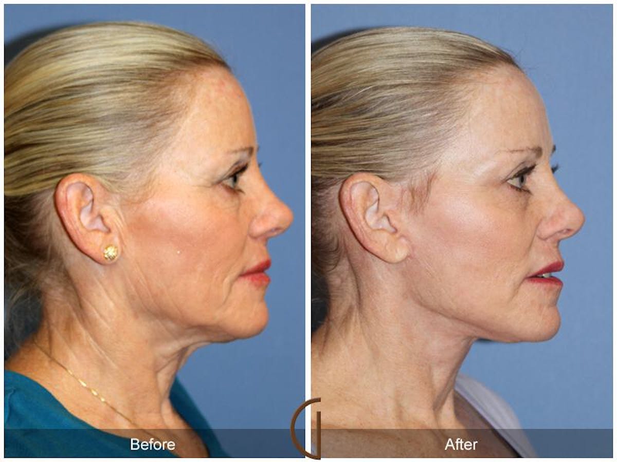 Facelift 60s Before & After Gallery - Patient 321373 - Image 3