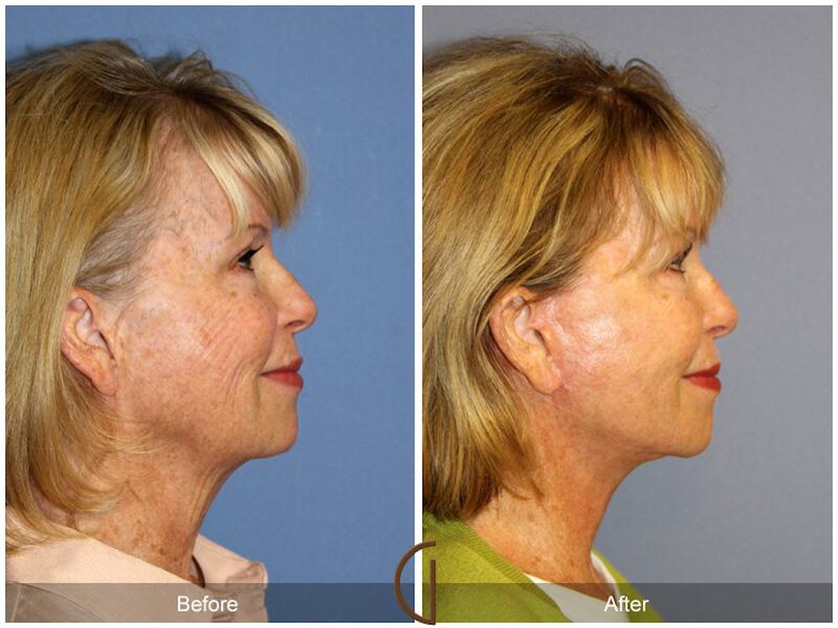 Facelift 60s Before & After Gallery - Patient 138907 - Image 3