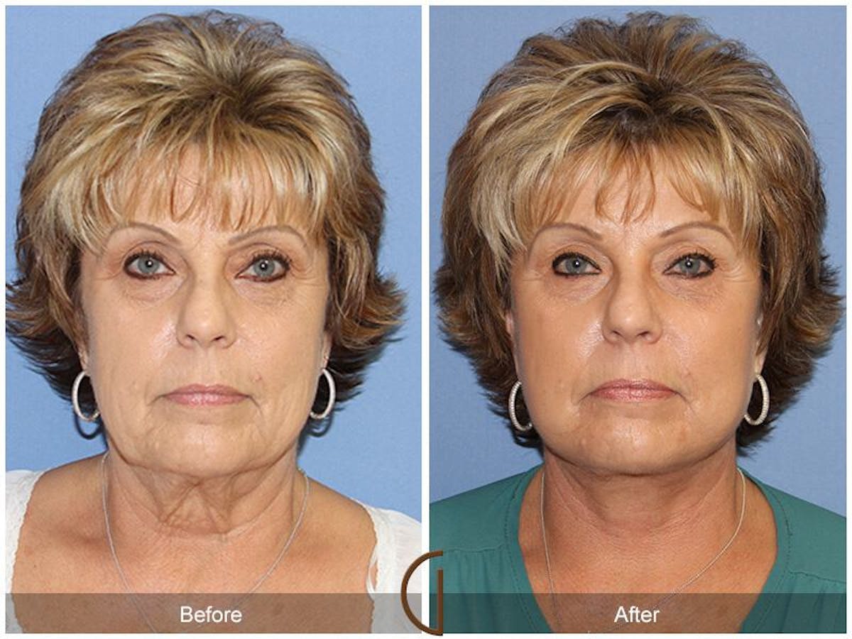Facelift 60s Before & After Gallery - Patient 428618 - Image 2