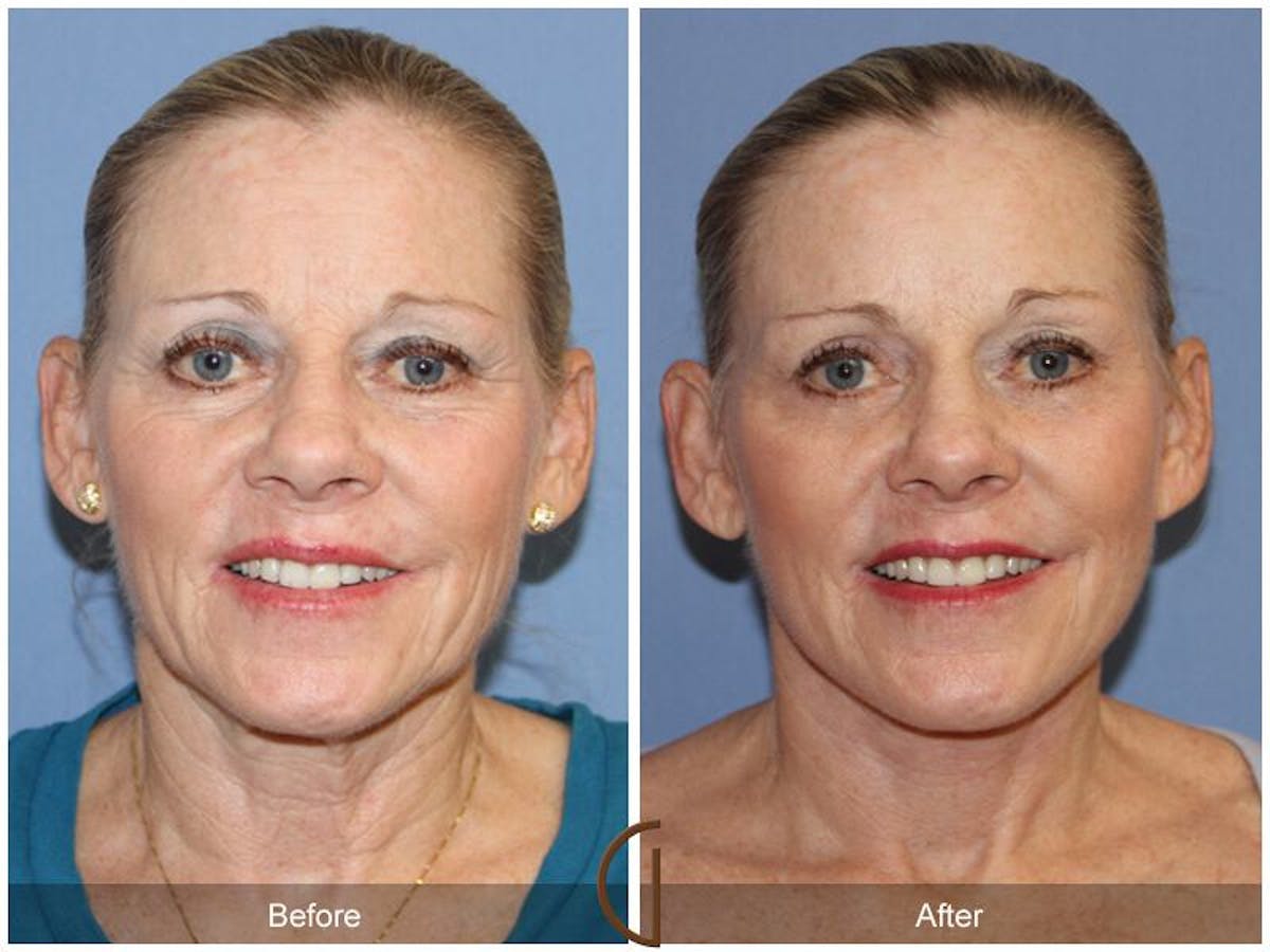Facelift 60s Before & After Gallery - Patient 321373 - Image 2