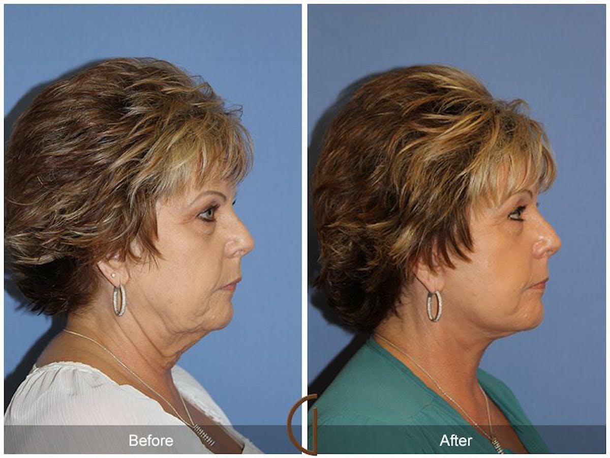 Facelift 60s Before & After Gallery - Patient 428618 - Image 3