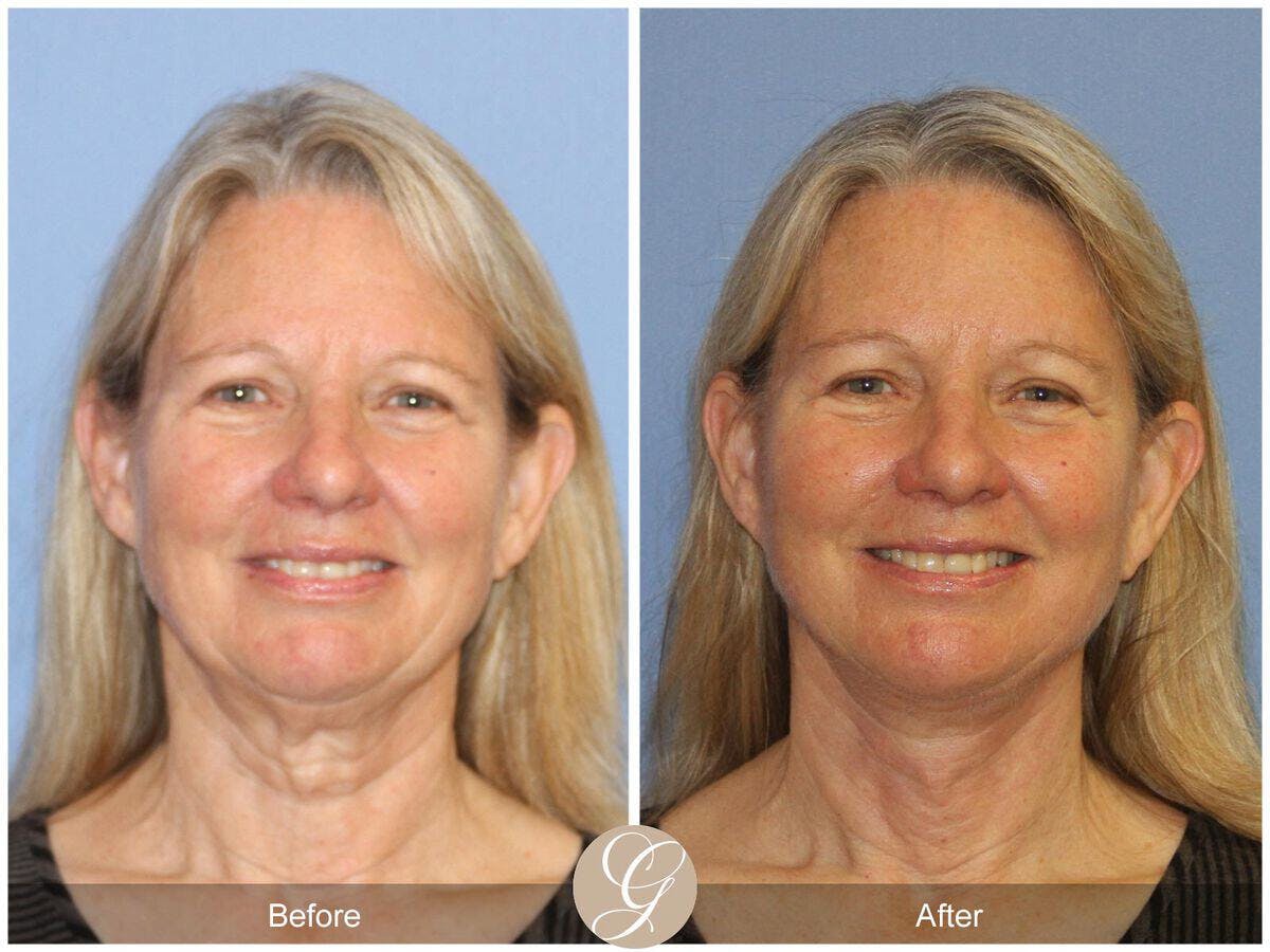 Facelift 60s Before & After Gallery - Patient 210319 - Image 2