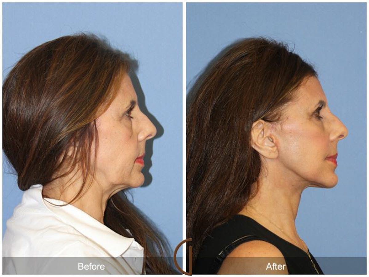 Facelift 60s Before & After Gallery - Patient 225974 - Image 3